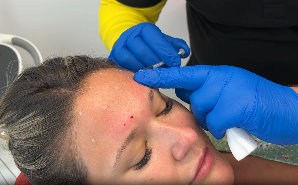 Injections du Botox dans le front.