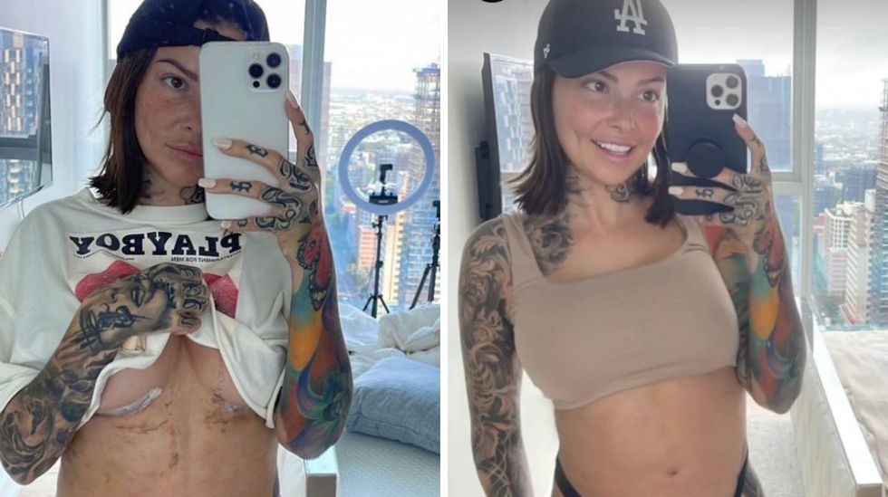 Une semaine apr\u00e8s son op\u00e9ration. Droite : 24 jours apr\u00e8s son op\u00e9ration.