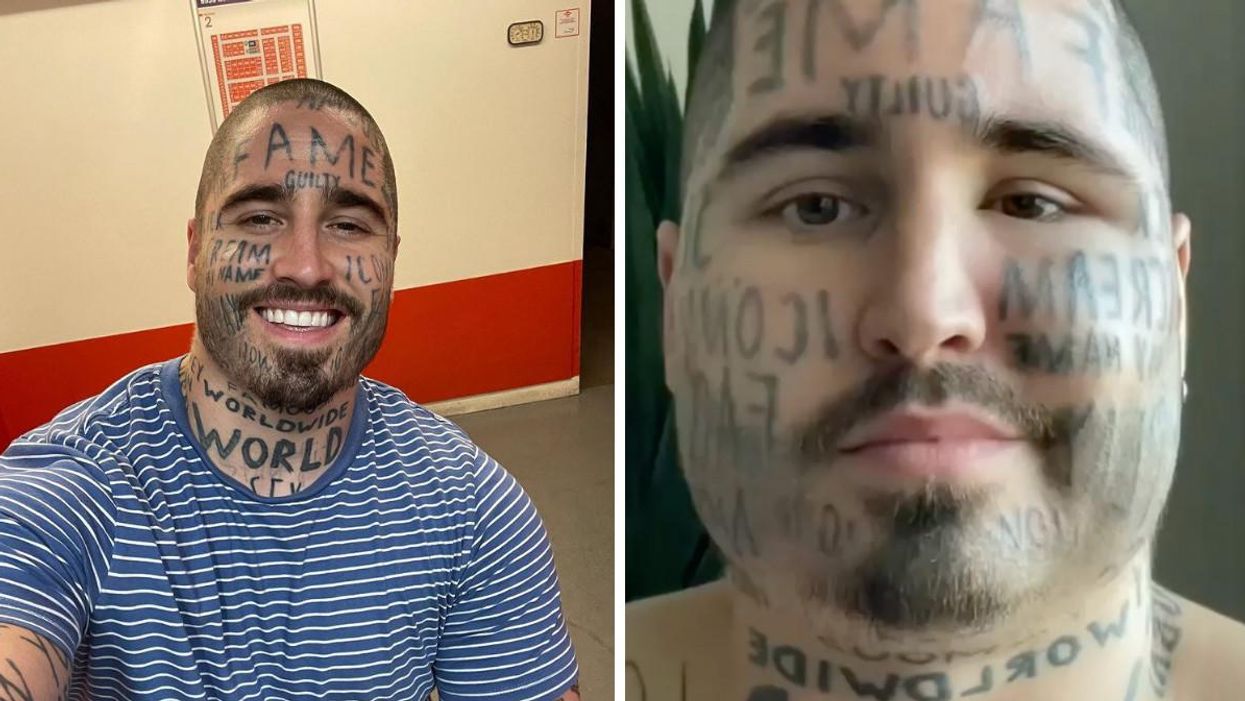 Vincent Langlois se confie sur son expérience de détatouage du visage